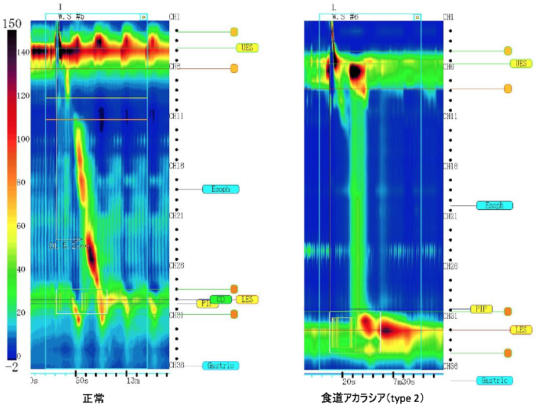 食道内圧測定のリスク